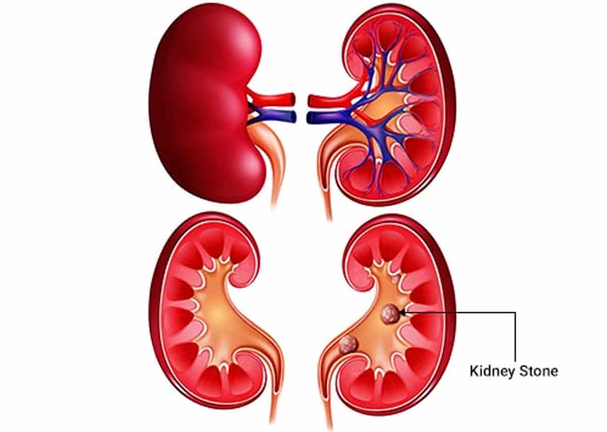 Kidney Stones - Frequently Asked Questions and Answers