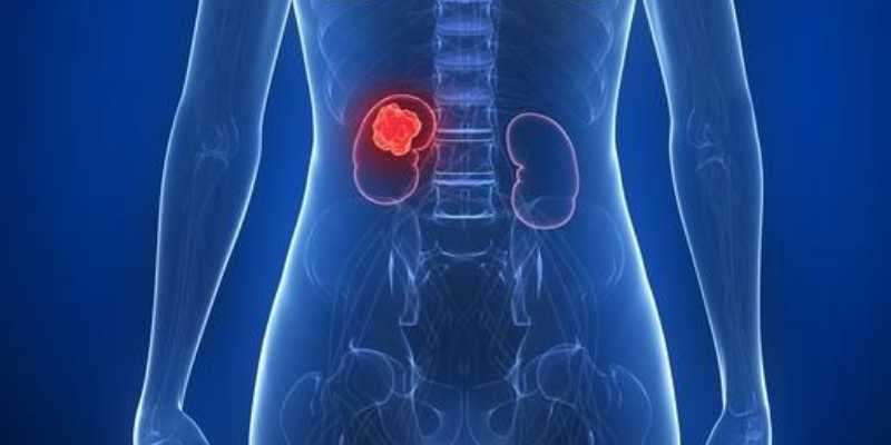 Kidney Cancer Treatment Cost in Delhi