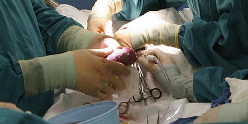 Kidney Transplant Doctor
