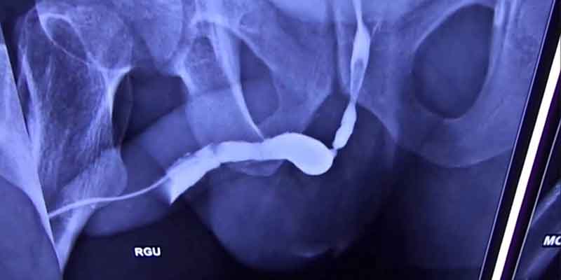 Stricture Urethra Treatment in Delhi